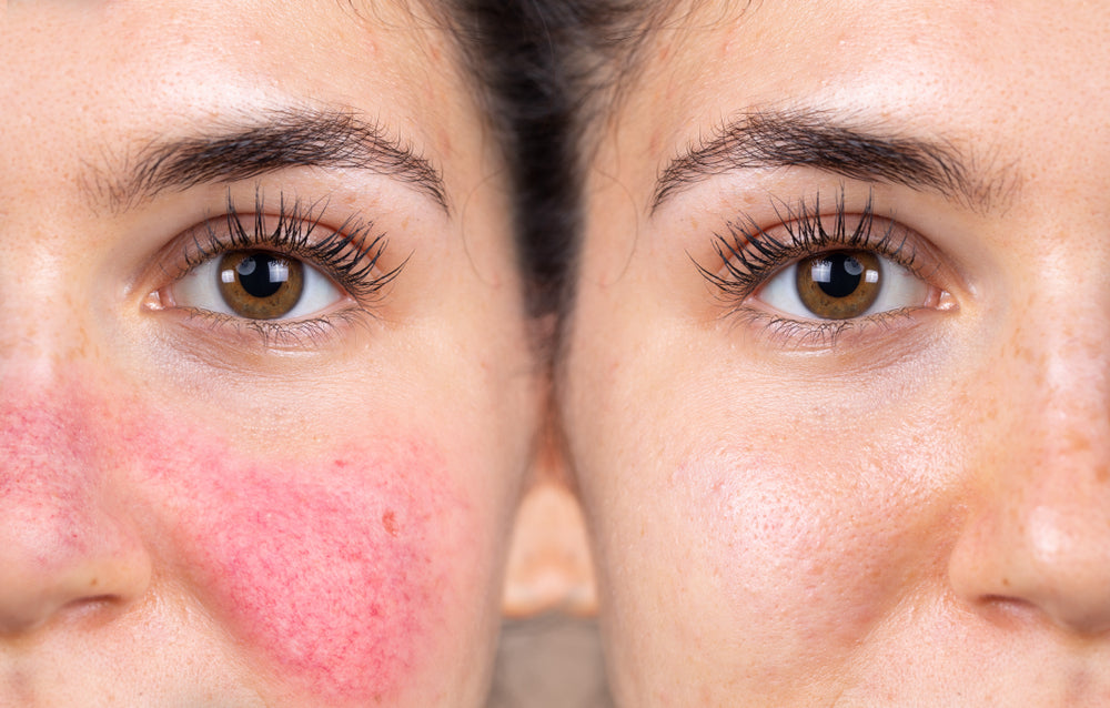 rosacea vs eczema